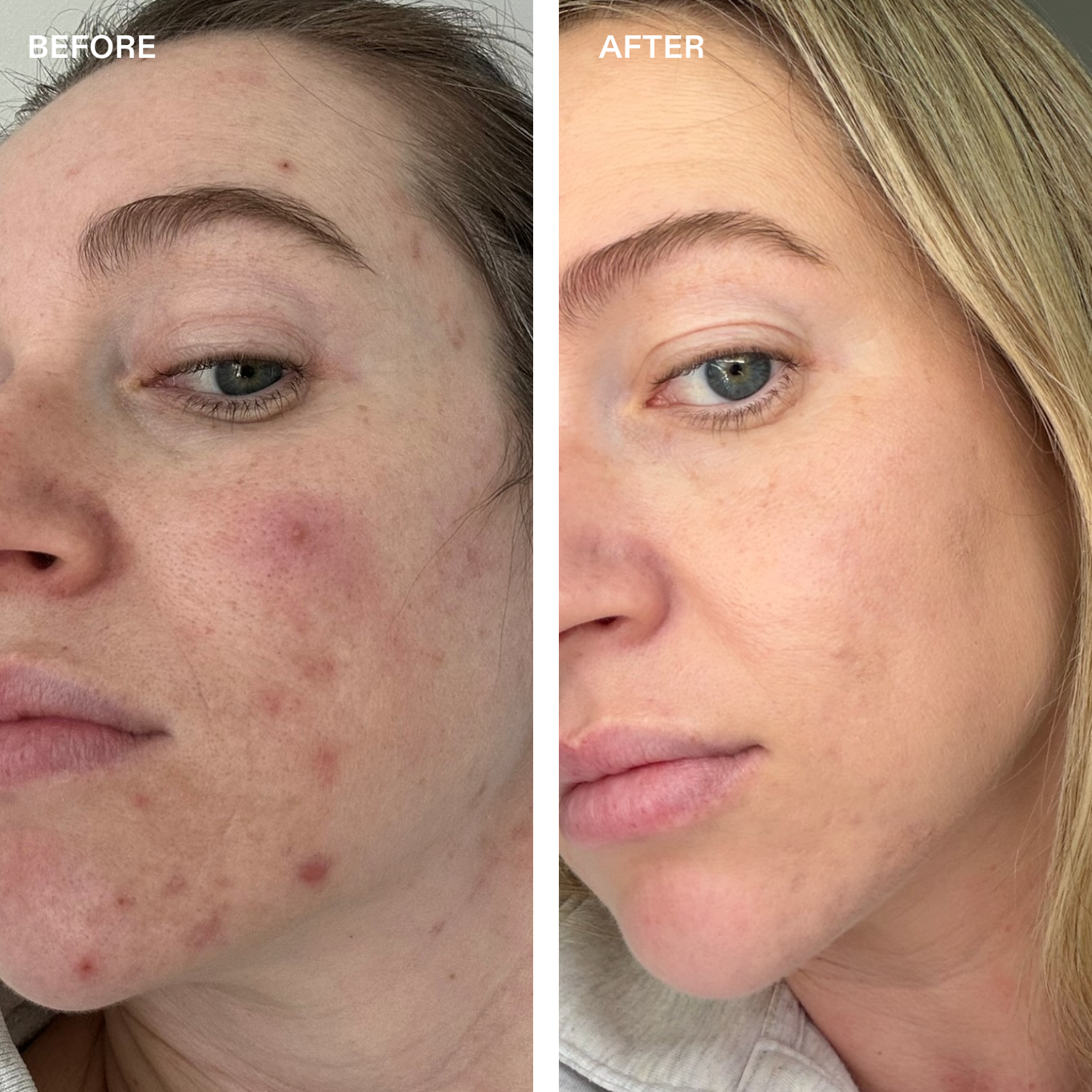 The Acne Kit