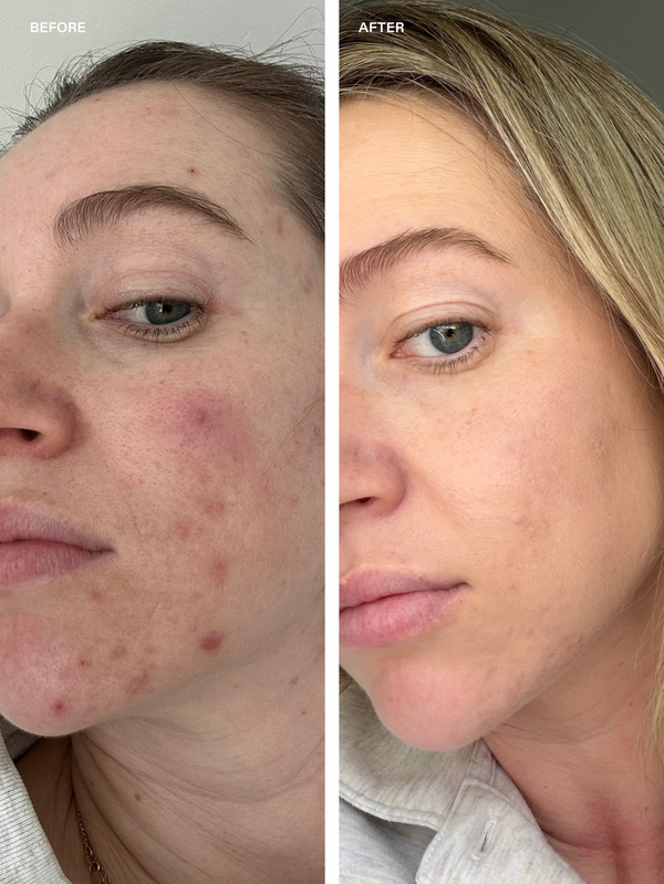 Acne Care That Cares for Your Skin